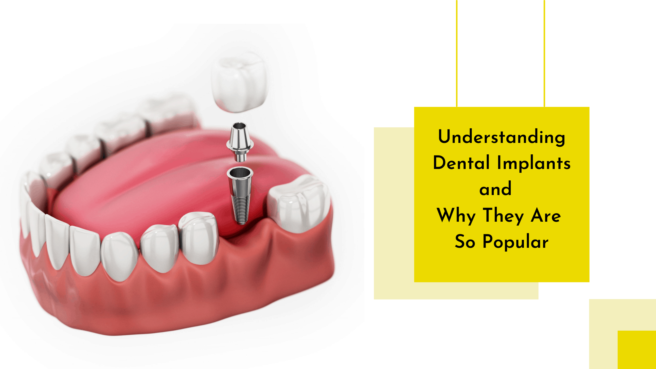 Understanding Dental Implants and Why They Are So Popular