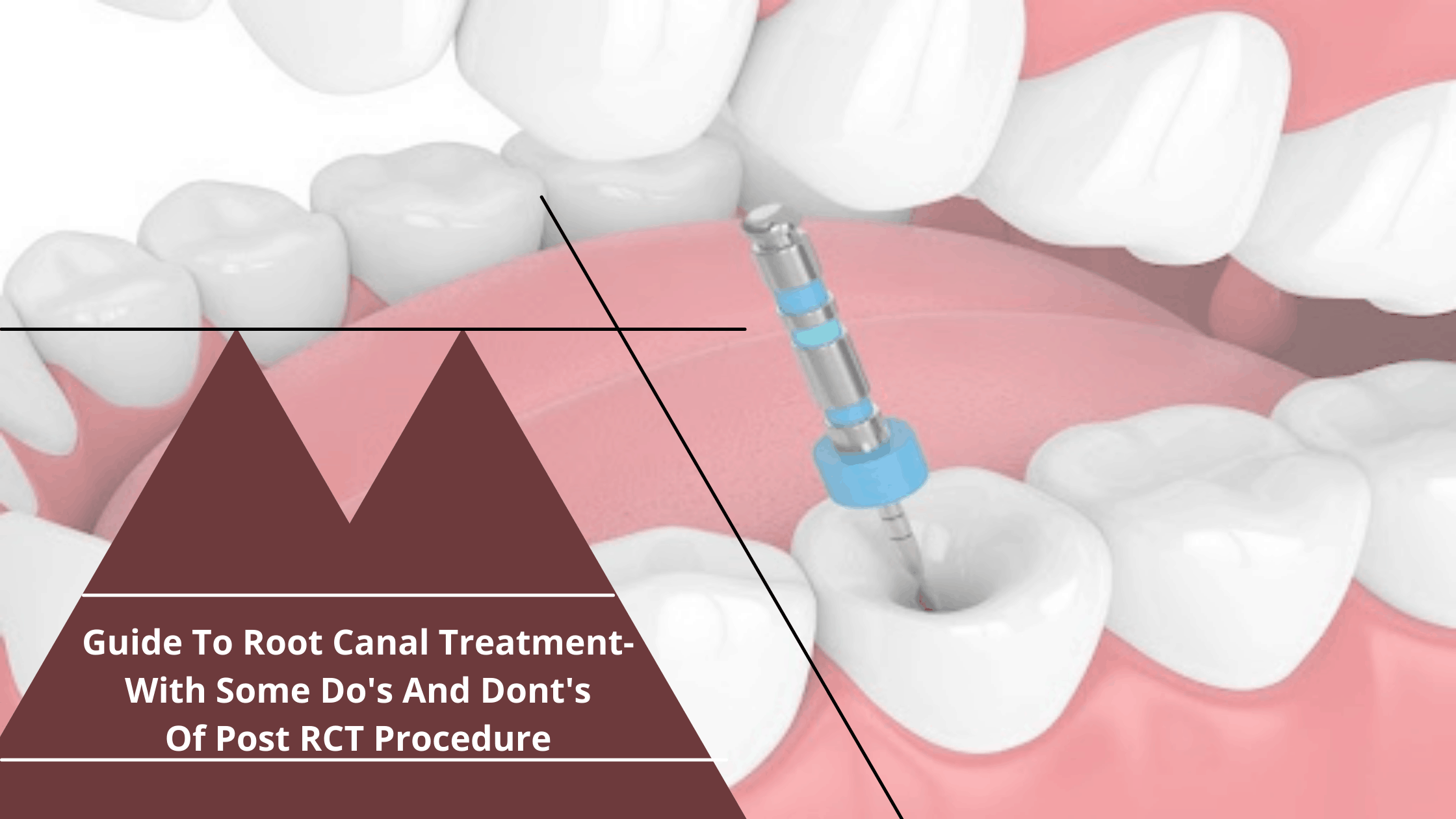 Guide To Root Canal Treatment- With Some Do’s And Dont’s Of Post RCT Procedure