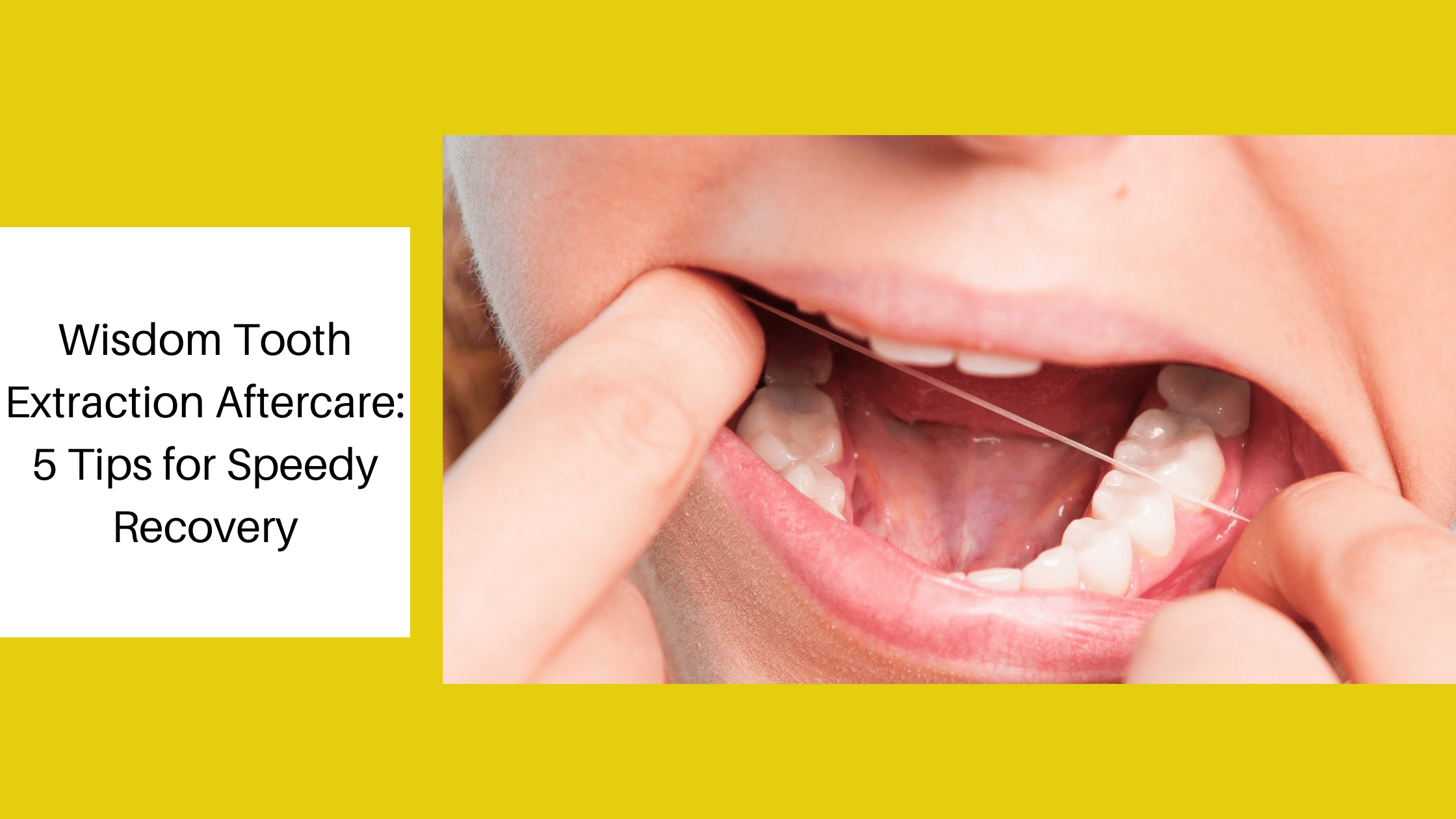 Wisdom Tooth Extraction Aftercare: 5 Tips for Speedy Recovery